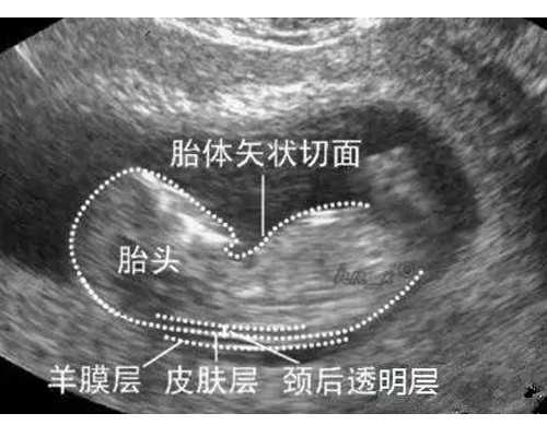 低分子肝素钠要怎么打？打屁股还是手臂？