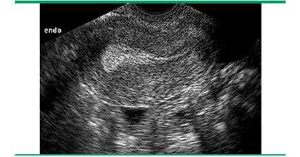 子宫切除后不会怀孕吗，习惯性流产做第三代试管，辟谣：还在为子宫内膜厚薄