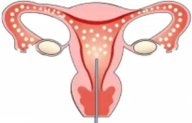 宫颈口狭窄影响怀孕吗，染色体异常为何会流产，医生，B超提示我有子宫畸形